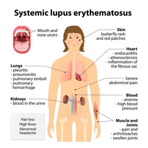 Lupus'un Gizemlerini Açığa Çıkarmak: Görünmez Bir Hastalığı Anlamak